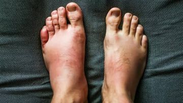 تورم القدمين في الصيف: أسباب شائعة ونصائح فعالة للتخفيف