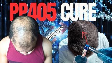 علاج جديد قد ينهي معاناة الصلع.. علماء أمريكيون يحققون اختراقا بجزيء PP405