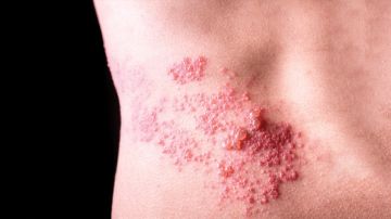 استشاري: مضاعفات الحزام الناري قد تصل إلى العمى.. فيديو استشاري: مضاعفات الحزام الناري قد تصل إلى العمى.. فيديو