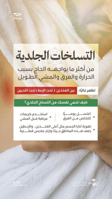 الصحة تحذر الحجاج من التسلخات الجلدية وتقدم إرشادات وقائية لتجنبها الصحة تحذر الحجاج من التسلخات الجلدية وتقدم إرشادات وقائية لتجنبها