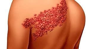 تحذير طبي: الحزام الناري قد يسبب العمى.. ويهدد كبار السن بمضاعفات خطيرة