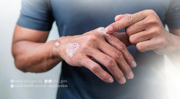 الصحي السعودي يقدم 6 إرشادات للمصابين بالصدفية في الشهر العالمي للتوعية