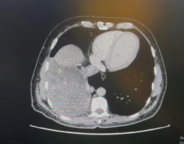 إنجاز طبي في جدة.. استئصال ورم نادر وخطير أسفل القلب بالمنظار الجراحي