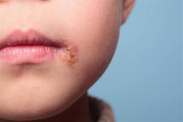 تقنية مبتكرة مناعية تحيد فيروس الهربس وتفتح آفاقا جديدة للوقاية