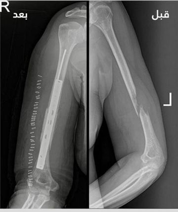 إعادة حركة يد خمسينية بعد جراحة دقيقة لأورام العظام في المدينة إعادة حركة يد خمسينية بعد جراحة دقيقة لأورام العظام في المدينة