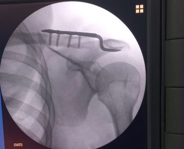 نجاح أول عملية نوعية لخلع المفصل الأخرمي الترقوي بمستشفى القويعية