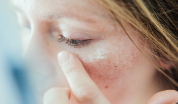 القبح الشتوي يطارد البشرات