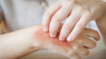 استشاري: 30 من أفراد المجتمع معرضون للإصابة للحزام الناري.. فيديو استشاري: 30 من أفراد المجتمع معرضون للإصابة للحزام الناري.. فيديو
