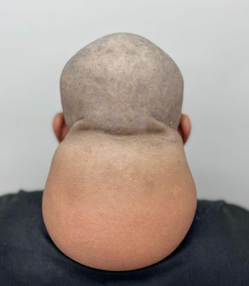 إنقاذ حياة ثلاثيني بعد إزالة ورم دهني ضخم بصبيا العام