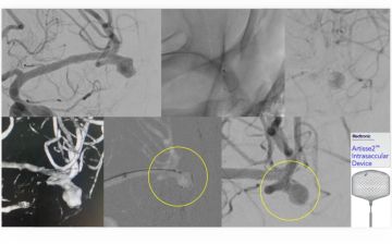 نجاح علاج مريض بتمدد شرياني دماغي في مستشفى الملك فهد الجامعي بالخبر