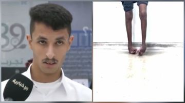 فيصل الحازمي يعود للمشي بعد 17 عاما من المعاناة مع القدم الحنفاء .. فيديو فيصل الحازمي يعود للمشي بعد 17 عاما من المعاناة مع القدم الحنفاء .. فيديو