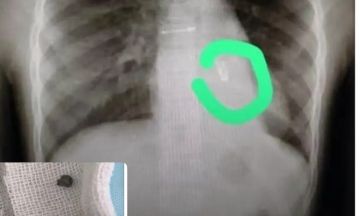 نجاح طبي نادر في حلب.. استخراج قطعة حديدية من رئة طفلة بعد معاناة استمرت أكثر من عام ونصف نجاح طبي نادر في حلب.. استخراج قطعة حديدية من رئة طفلة بعد معاناة استمرت أكثر من عام ونصف