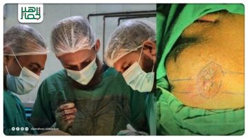 مشفى منبج الوطني يجري عملية نوعية لاستئصال التهاب العظم بالفك السفلي مشفى منبج الوطني يجري عملية نوعية لاستئصال التهاب العظم بالفك السفلي