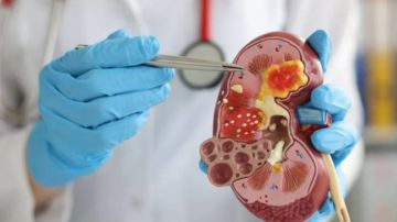 السخيري: 9 بالمائة من التونسيين مصابون بأمراض الكلى السخيري: 9 بالمائة من التونسيين مصابون بأمراض الكلى