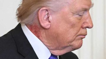 طبيب ترامب: الرئيس يستخدم علاجا وقائيا لطفح جلدي في رقبته