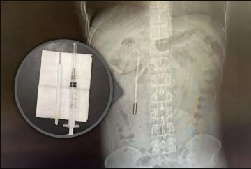 صيني عانى من ألم في المعدة لسبب لايصدق