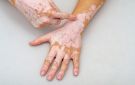 في إنجاز طبي هو الأول عالميا.. الإمارات تفتك بـ لغز البهاق غير القطعي Non-segmental vitiligo