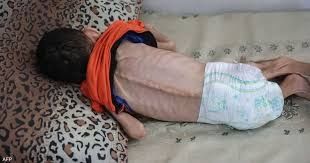 ارتفاع وفيات الأطفال في غزة بنسبة 230 بسبب سوء التغذية