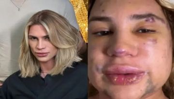 وفاة المؤثر البرازيلي جونيور دوترا بعد مضاعفات جراحة عيون الثعلب تثير صدمة وجدلا طبيا