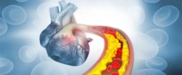 خمسة أطعمة يومية لكن تأثيرها على الشرايين سيدهشك