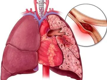 اكتشف العلامات الخفية للانسداد الرئوي وفحوصات ضرورية للتشخيص المبكر اكتشف العلامات الخفية للانسداد الرئوي وفحوصات ضرورية للتشخيص المبكر