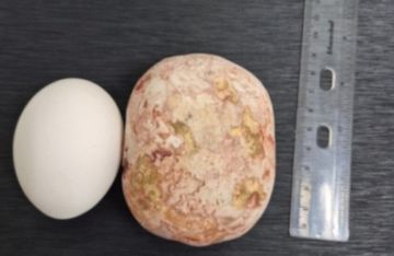 أطباء روس يستخرجون حصوة عملاقة تزن 1 كلغ من مثانة رجل