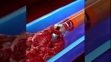 بالخطأ تم اكتشافه.. جهاز طبي أمريكي حديث يحدث ثورة في علاج الجلطات الدموية بالخطأ تم اكتشافه.. جهاز طبي أمريكي حديث يحدث ثورة في علاج الجلطات الدموية