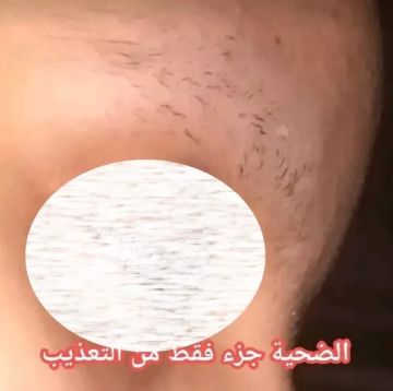 محام يعذب زوجته ويحلق شعرها ويحرق جسدها بطريقة مروعة منذ أشهر في تعز