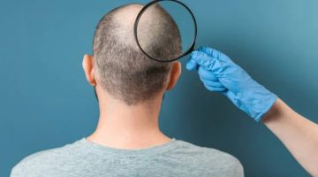 الدواء الأشهر لعلاج الصلع: هل هو آمن على الصحة النفسية؟ الدواء الأشهر لعلاج الصلع: هل هو آمن على الصحة النفسية؟