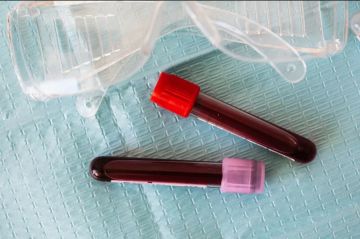 مخزون الحديد الطبيعي للنساء وكيفية رفعه وفق طبيبة