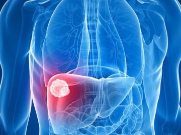 الكبد الدهني.. العلامات المبكرة التي يمكنك ملاحظتها في المنزل