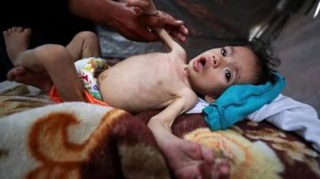 الأونروا: 508 أطفال في قطاع غزة مصابون بسوء التغذية الحاد