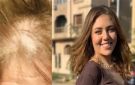 بعد أزمة رحمة حسن.. 8 أطعمة أساسية لتقوية الشعر ومنع التساقط