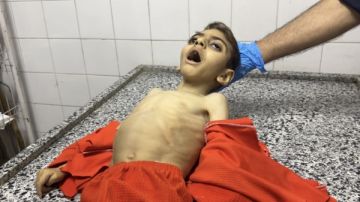 21 طفلا يفقدون حياتهم بسبب سوء التغذية خلال 72 ساعة في غزة