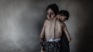 تسجيل 4 حالات وفاة بسبب المجاعة في غزة خلال الـ24 ساعة الماضية