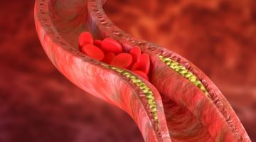 5 أسباب لانسداد الشرايين و3 طرق للتشخيص.. تعرف عليها 5 أسباب لانسداد الشرايين و3 طرق للتشخيص.. تعرف عليها