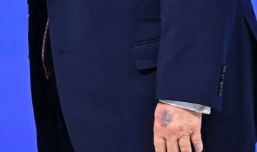 كدمات جديدة تظهر على يد الرئيس الأمريكي تثير تكهنات كثيرة... وترامب يرد