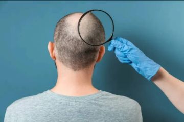 (البالدماكسينغ) سيحميك.. لا داعي للخوف من الصلع من الآن