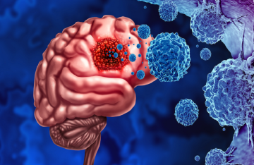 باحثون يطورون تقنية سريرية لعلاج أورام الدماغ لدى الأطفال