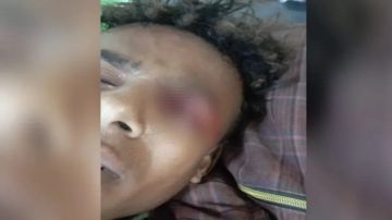 الألعاب النارية تفسد فرحة شاب بعيد الفطر عقب إصابة خطيرة في عينه الألعاب النارية تفسد فرحة شاب بعيد الفطر عقب إصابة خطيرة في عينه