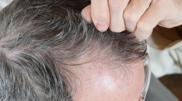 علماء يبتكرون مصلا نباتيا قد يعيد إنبات الشعر خلال أسابيع