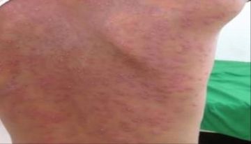 عشرات الإصابات بمرض الجدري تجتاح منطقة بلاد الأحمدي بالأزارق