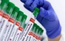 السند الباكستاني يسجل إصابة جديدة بجدري القرود